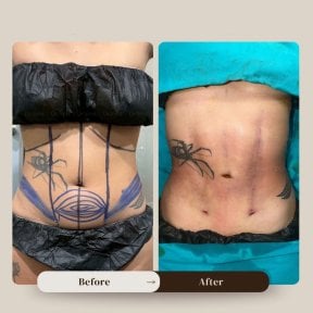 Before and after liposuction results at Intrarat Hospital, visible abdominal contour improvement