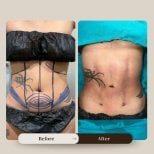 Before and after liposuction results at Intrarat Hospital, visible abdominal contour improvement