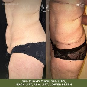 before-after photo lower-body-lift