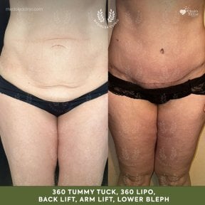 before-after photo lower-body-lift