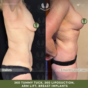before-after photo lower-body-lift