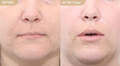 before-after photo podtyazhka-gub