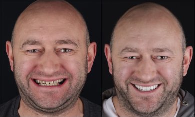 Before and after All-on-4 dental implants result at RIKOTA Dental Clinic, restored smile
