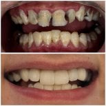 نتائج قبل وبعد ترميم الأسنان (تجميل) في عيادة سبانداريشفيلي للأسنان