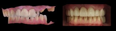 before-after photo tooth-reshaping