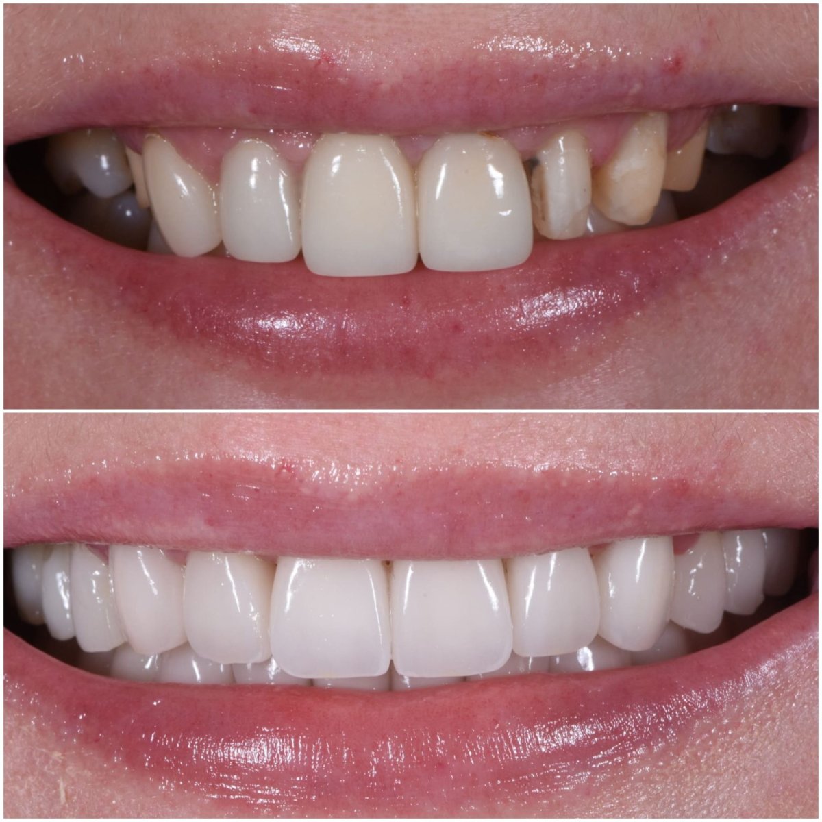 Resultados antes y después de carillas dentales – sonrisa mejorada y dientes más blancos
