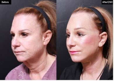 Результаты до и после подтяжки лица в VG Plastic Surgery – видимое омоложение и лифтинг