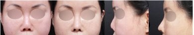 before-after photo rhinoplasty-nose-job
