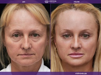 Результаты блефаропластики бровей до и после в Vidnova Clinic – омоложение лба и глаз