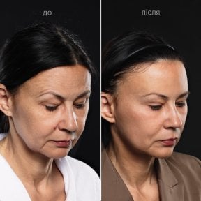 before-after photo podtazka-brovej