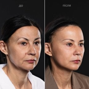 before-after photo podtazka-brovej