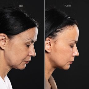 before-after photo podtazka-brovej