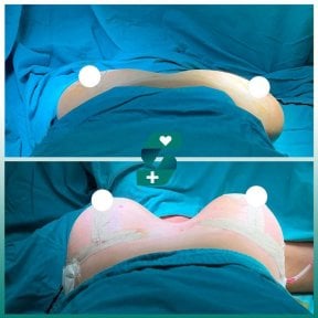 before-after photo breast-implant-revision