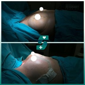 before-after photo breast-implant-revision