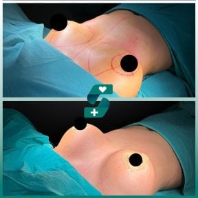 before-after photo breast-implant-revision