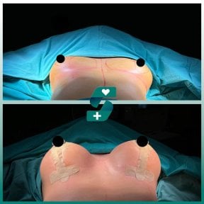 before-after photo breast-implant-revision