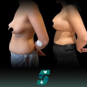 before-after photo breast-implant-revision