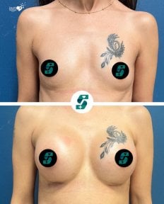 before-after photo breast-implant-revision