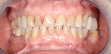 before-after photo zirconia-crown-installation