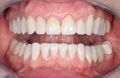 before-after photo zirconia-crown-installation