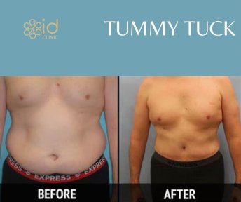 Resultados de abdominoplastia antes y después en ID Clinic Bangkok, mejora del contorno abdominal
