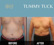 Resultados de abdominoplastia antes y después en ID Clinic Bangkok, mejora del contorno abdominal