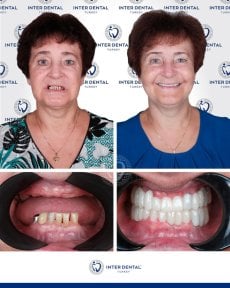 Результаты имплантации зубов до и после в Inter Dental Turkey – восстановленная улыбка