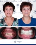 Результаты имплантации зубов до и после в Inter Dental Turkey – восстановленная улыбка