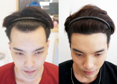 Результат до и после пересадки волос FUE в Dr.Orn Clinic : Medical Hair, улучшенная линия волос