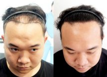 Результат пересадки волос FUE до и после в Dr.Orn Clinic : Medical Hair, улучшенная линия волос