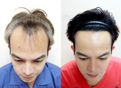 Результат пересадки волос FUE до и после в Dr.Orn Clinic : Medical Hair, улучшенная линия волос