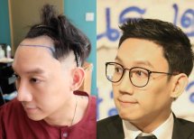 Результат до и после пересадки волос FUE в Dr.Orn Clinic : Medical Hair, улучшенная линия волос