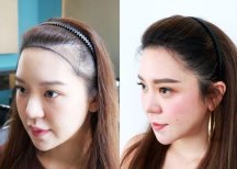 Результат пересадки волос FUE до и после в Dr.Orn Clinic : Medical Hair, улучшенная линия роста