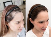 Результат пересадки волос FUE до и после в Dr.Orn Clinic : Medical Hair, улучшенная линия роста