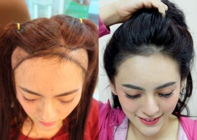 До и после пересадки волос FUE в Dr.Orn Clinic : Medical Hair, восстановленная линия роста
