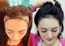 До и после пересадки волос FUE в Dr.Orn Clinic : Medical Hair, восстановленная линия роста