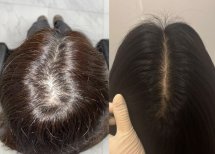 До и после пересадки волос FUE в Dr.Orn Clinic : Medical Hair, видимый результат густоты