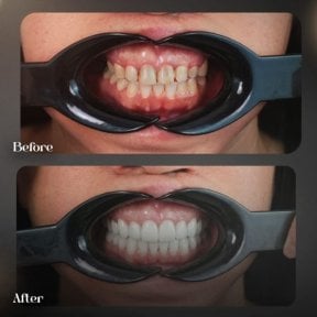 before-after photo hollywood-smile
