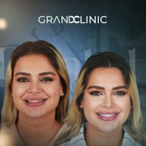 before-after photo hollywood-smile