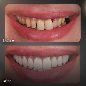 before-after photo hollywood-smile