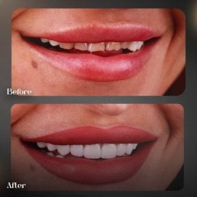 before-after photo hollywood-smile