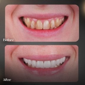 before-after photo hollywood-smile