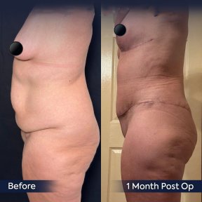 before-after photo abdominoplasty
