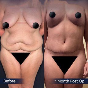 before-after photo abdominoplasty