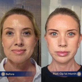before-after photo glubokaya-podtyazhka-lica-deep-plane-facelift