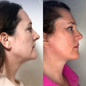 before-after photo glubokaya-podtyazhka-lica-deep-plane-facelift