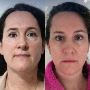 before-after photo glubokaya-podtyazhka-lica-deep-plane-facelift
