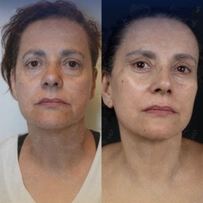 before-after photo glubokaya-podtyazhka-lica-deep-plane-facelift