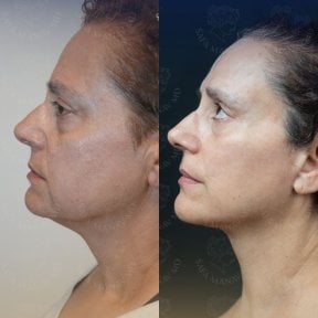 before-after photo glubokaya-podtyazhka-lica-deep-plane-facelift