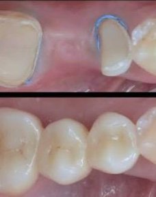 before-after photo implantacia-zuba